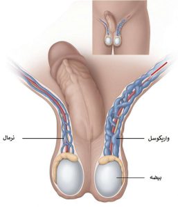 تصاویر واریکوسل