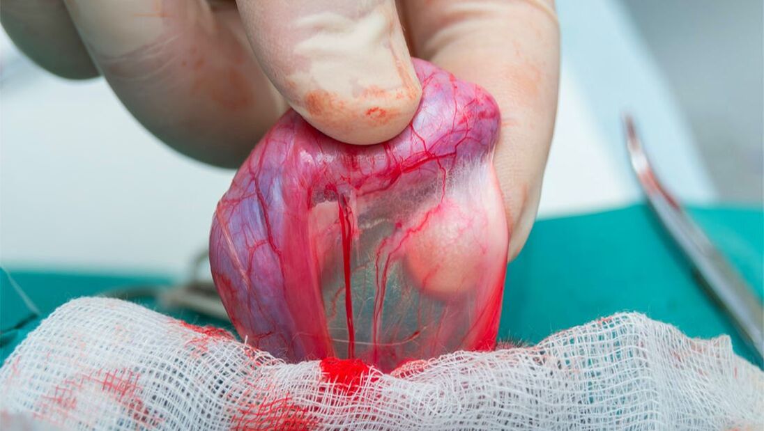 واریکوسل گرید 2