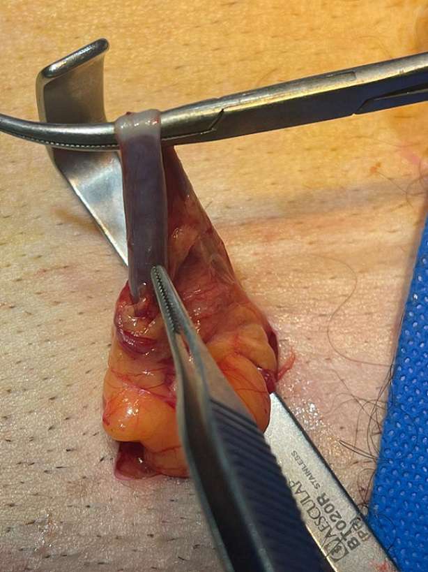 عکس عمل واریکوسل (میکروسکوپیک)