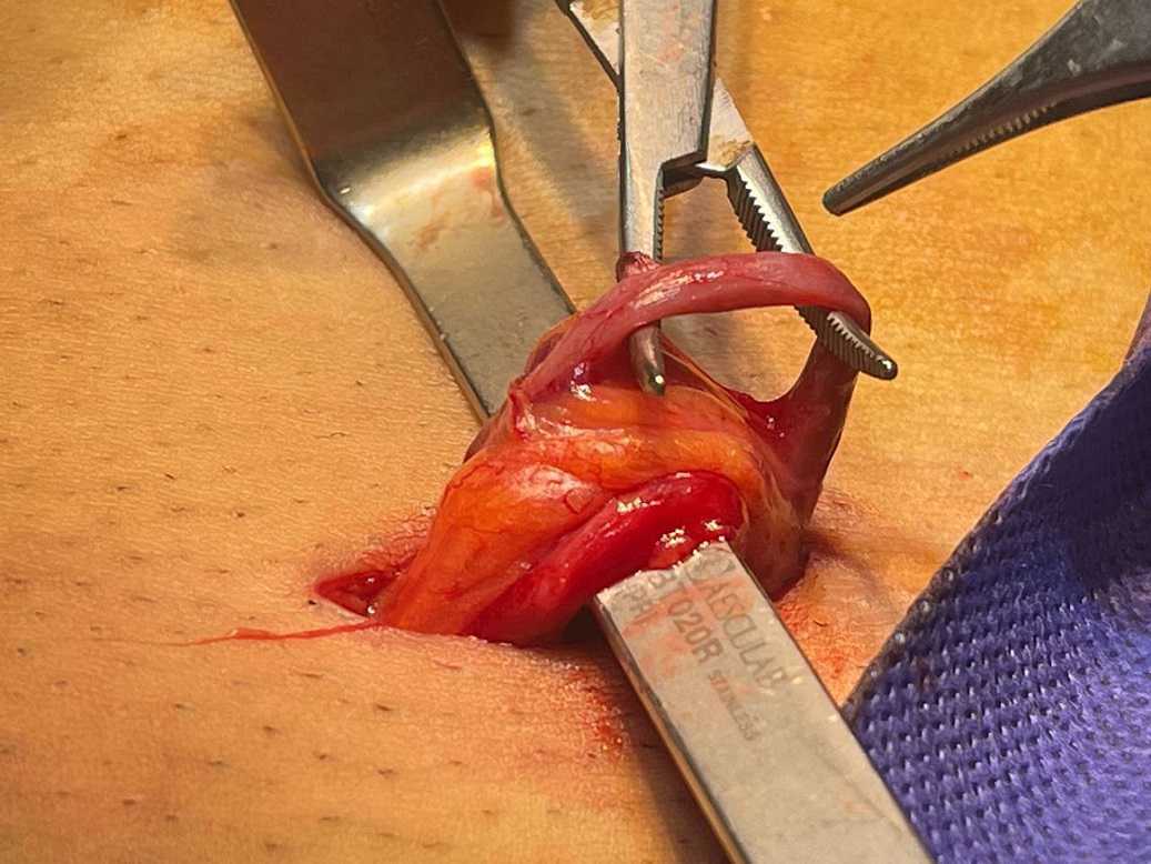 عکس عمل واریکوسل (میکروسکوپیک)