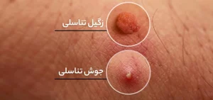 تفاوت جوش و زگیل تناسلی