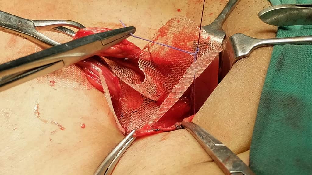 Mesh,Repair,With,Isolated,Spermatid,Cord,In,Inguinal,Hernia,Surgery,