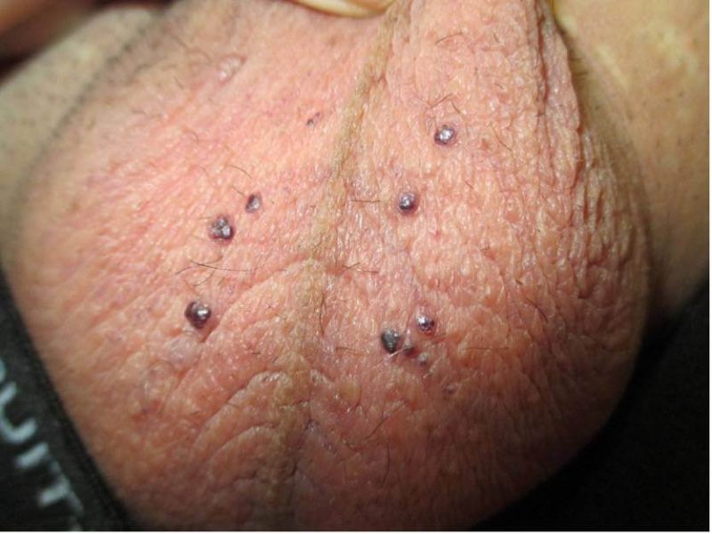 جوش روی بیضه
